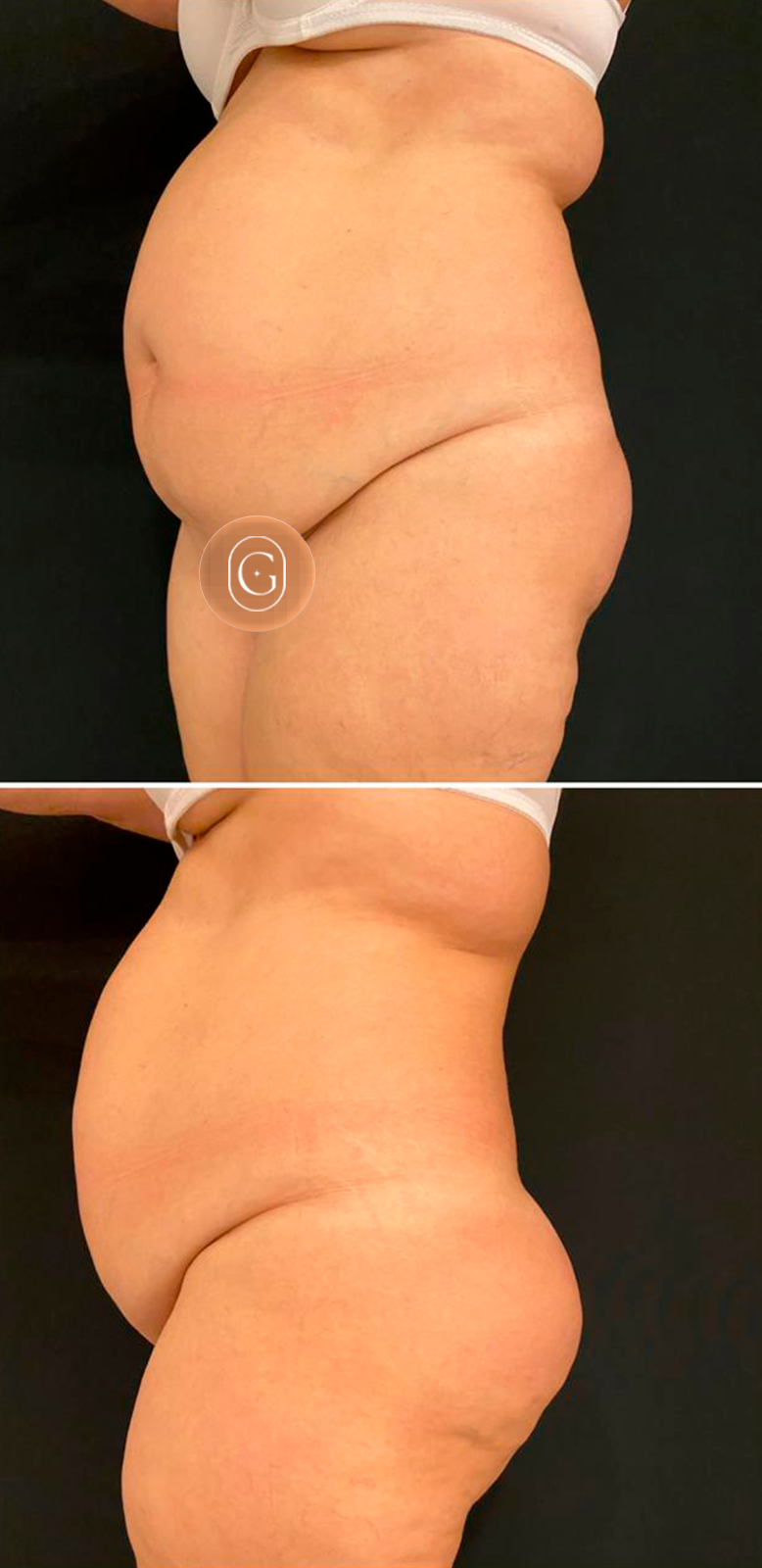 Antes de cirurgia do contorno corporal, caso 1, imagem publicada com autorização da paciente