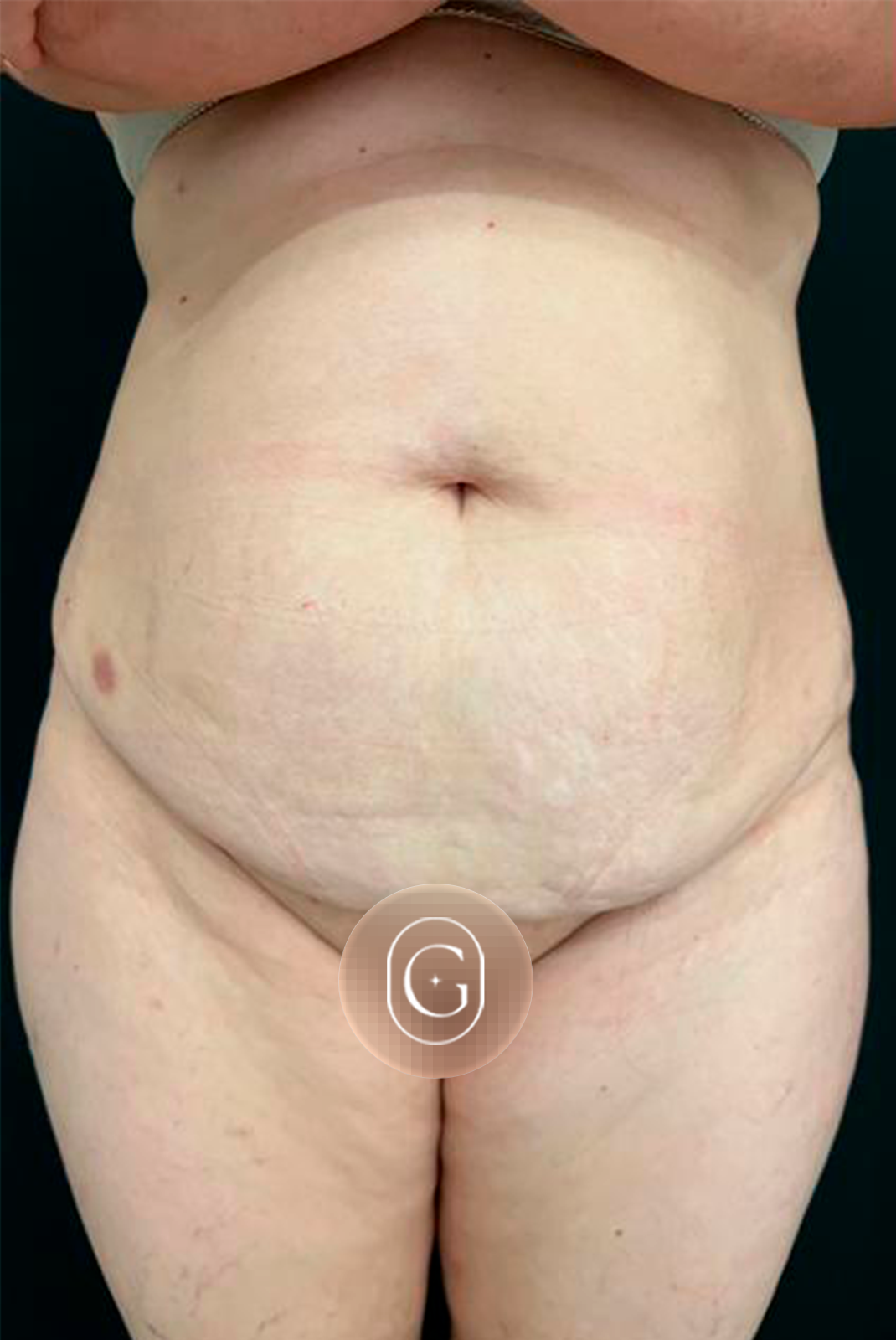 Antes de cirurgia do contorno corporal, caso 2, imagem publicada com autorização da paciente
