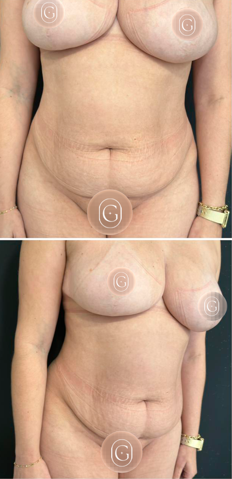 Antes de cirurgia do contorno corporal, caso 3, imagem publicada com autorização da paciente