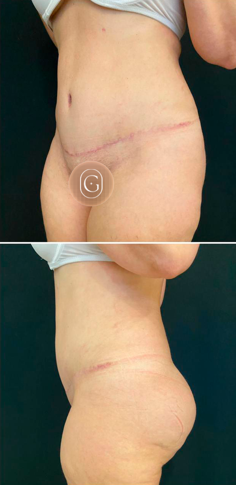 Depois de cirurgia do contorno corporal, caso 1, imagem publicada com autorização da paciente