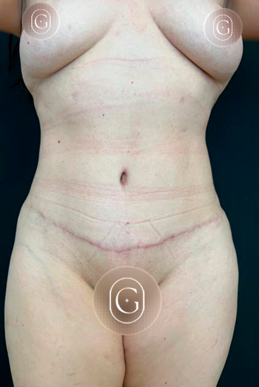 Depois de cirurgia do contorno corporal, caso 2, imagem publicada com autorização da paciente
