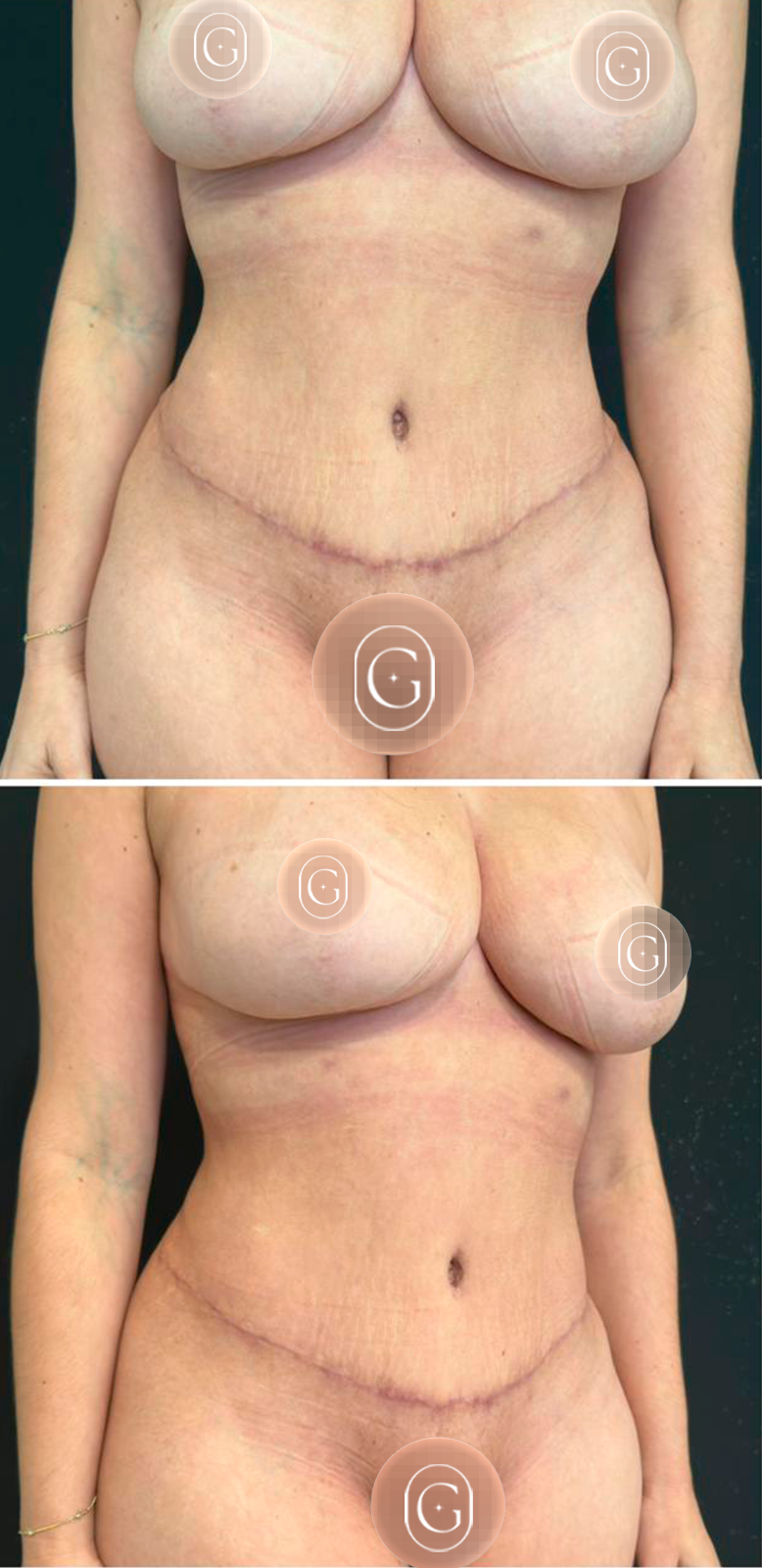 Depois de cirurgia do contorno corporal, caso 3, imagem publicada com autorização da paciente