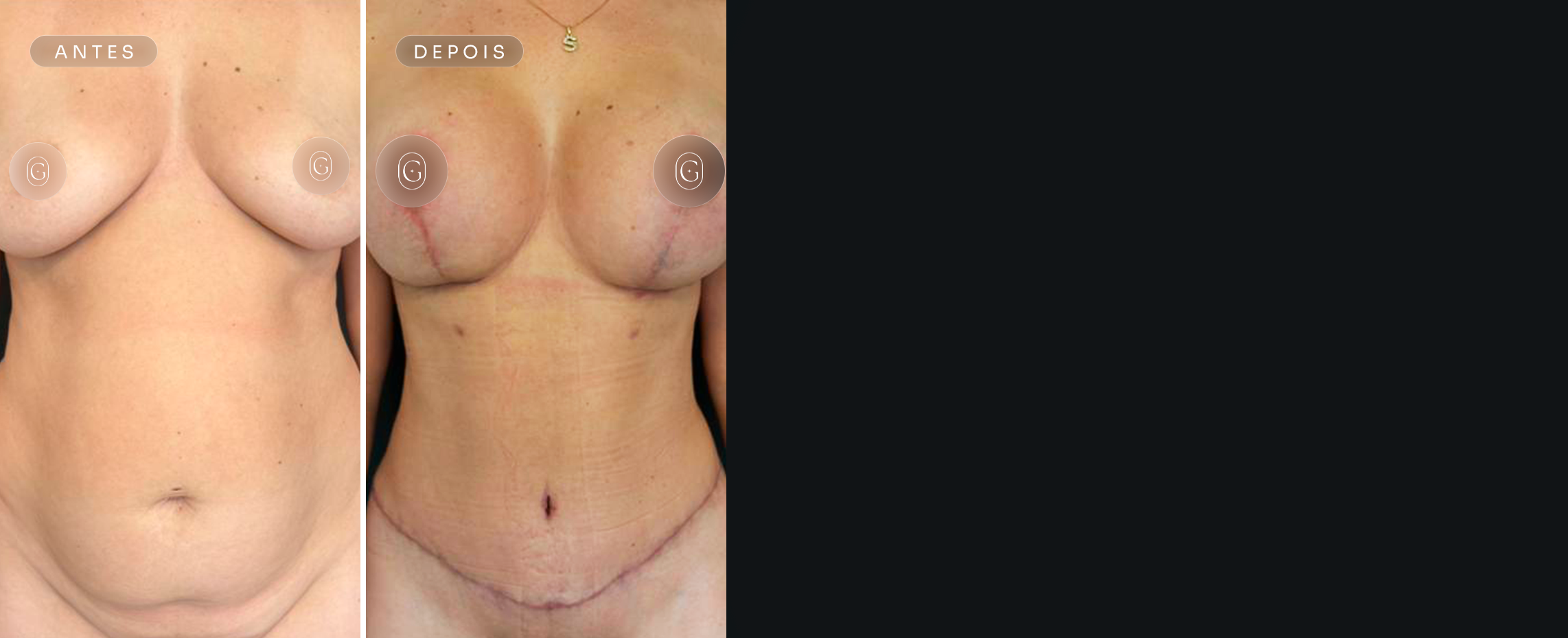 Resultados de cirurgia do contorno corporal do Dr. Gustavo Leite, imagens publicadas com autorização das pacientes
