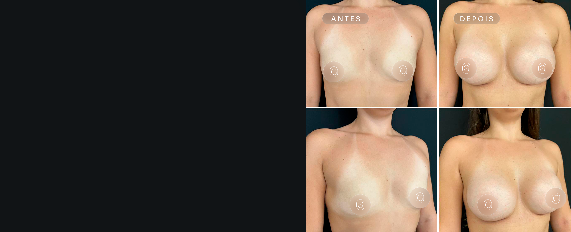 Resultados de cirurgia das mamas do Dr. Gustavo Leite, imagens publicadas com autorização das pacientes