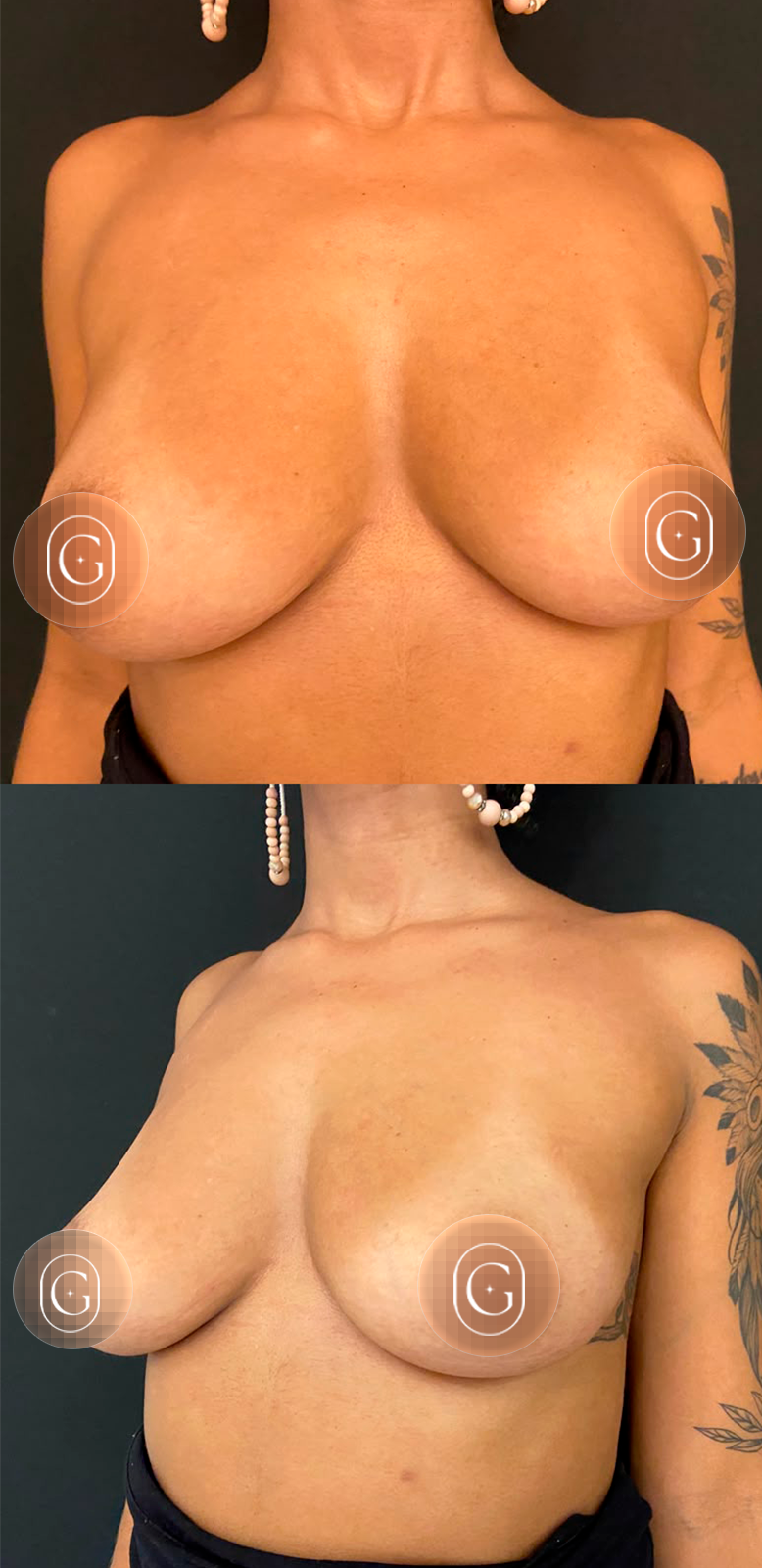 Antes da mastopexia com prótese pela técnica Minimal Short Scar, imagem publicada com autorização da paciente