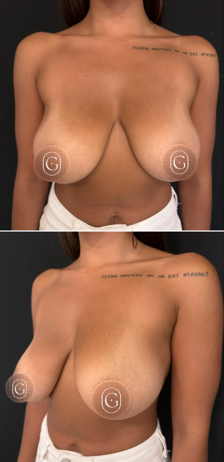Antes da mastopexia sem prótese pela técnica Minimal Short Scar, imagem publicada com autorização da paciente