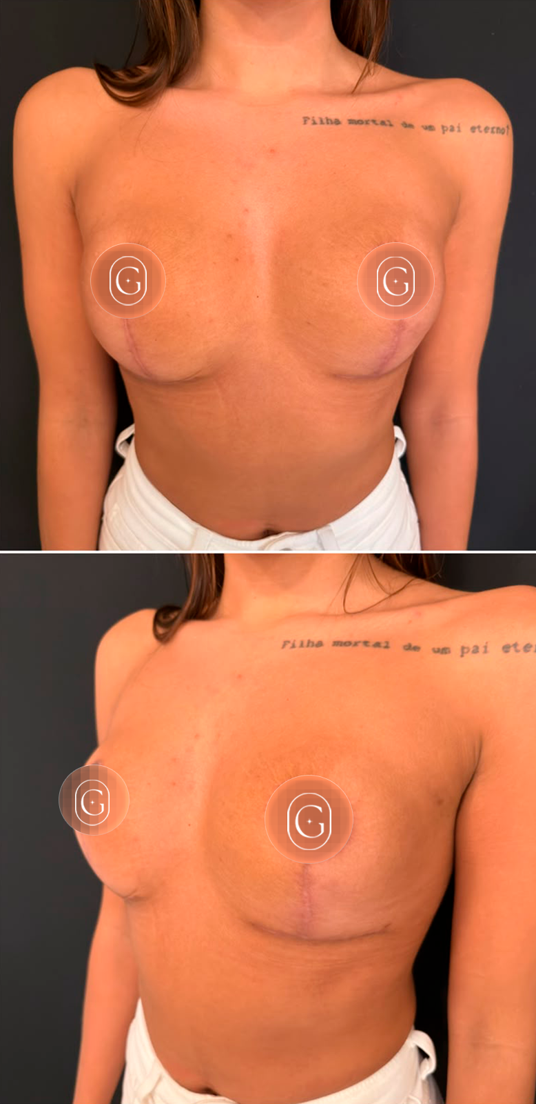 Depois da mastopexia sem prótese pela técnica Minimal Short Scar, imagem publicada com autorização da paciente